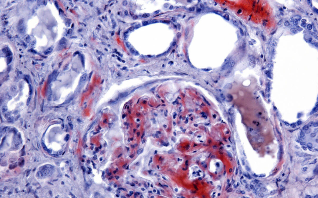 Stump the Clumps: Treating Amyloidosis